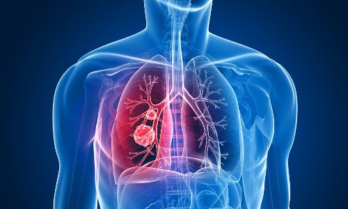 Aquejado de una lesión pulmonar maligna, el camagüeyano Pedro Frómeta, de 65 años, sintió alivio, aun ante la abrumadora noticia, por estar entre los pacientes atendidos por un equipo multidisciplinario del Hospital Manuel Ascunce Doménech (MAD), de la provincia de Camagüey. Aquejado de una lesión pulmonar maligna, el camagüeyano Pedro Frómeta, de 65 años, sintió alivio, aun ante la abrumadora noticia, por estar entre los pacientes atendidos por un equipo multidisciplinario del Hospital Manuel Ascunce Doménech (MAD), de la provincia de Camagüey.
