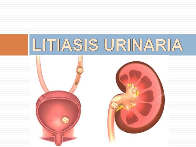 0529-litiasis-urinaria-1-638.jpg