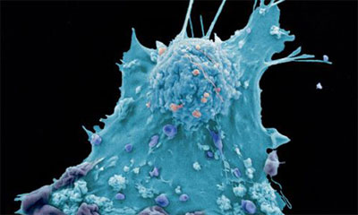 Imagen de una célula cancerosa de mama. celula_cancerigena.jpg