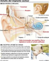 infografia_implante.jpg